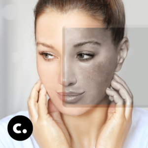 Rosewater for Dark Spots